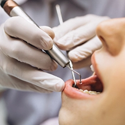 جراحی ایمپلنت