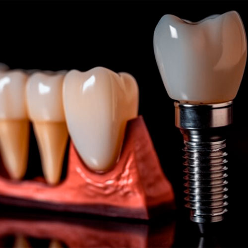 ایمپلنت یک روزه چیست؟