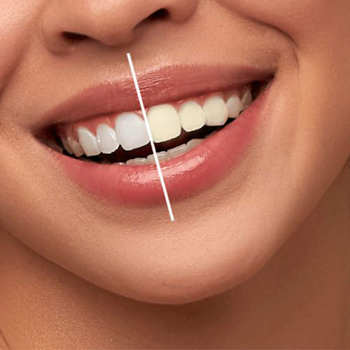 انواع روش‌های بلیچینگ دندان