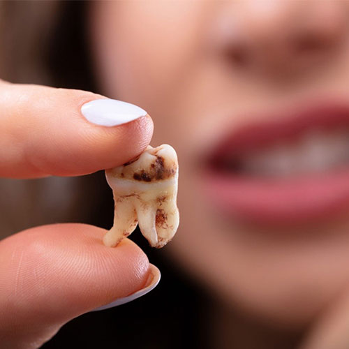 پوسیدگی دندان