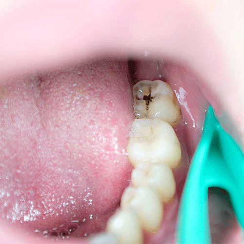 ترمیم دندان