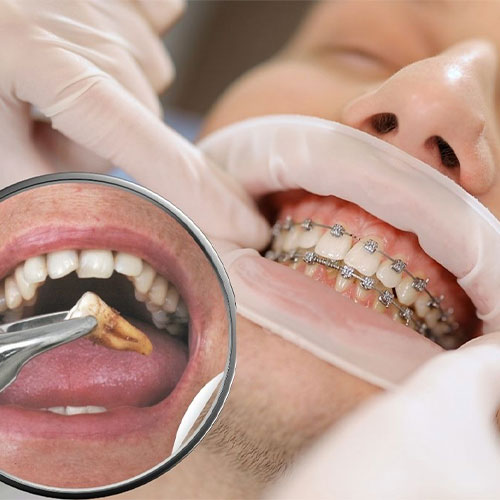 کشیدن جراحی (Surgical Extraction)