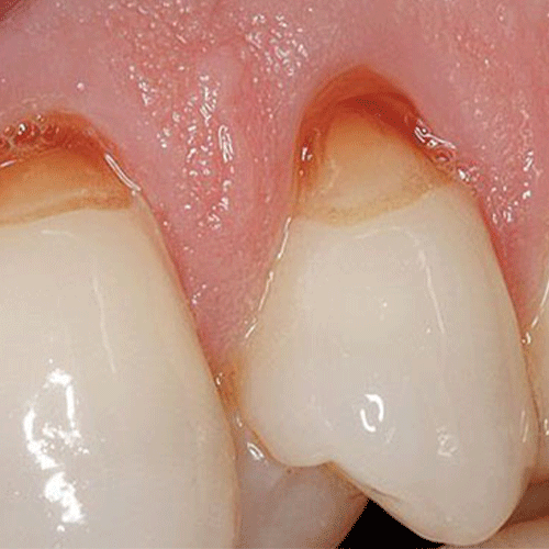 روش‌های درمان حساسیت دندانی