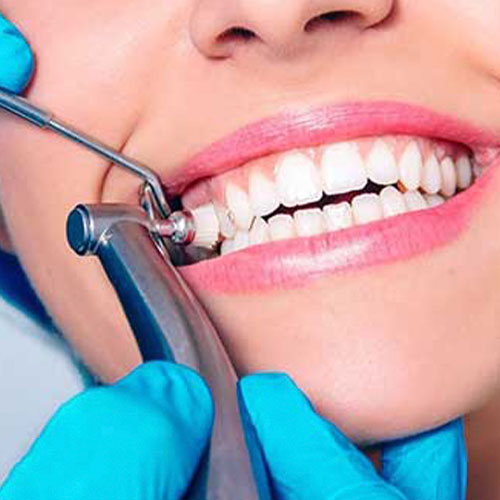 مراحل پولیش دندان