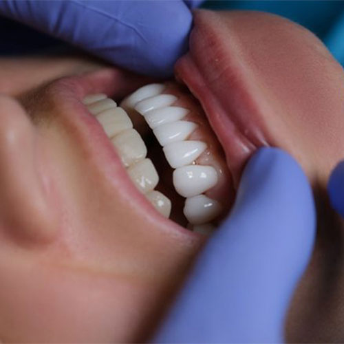 طول عمر و دوام کامپوزیت دندان