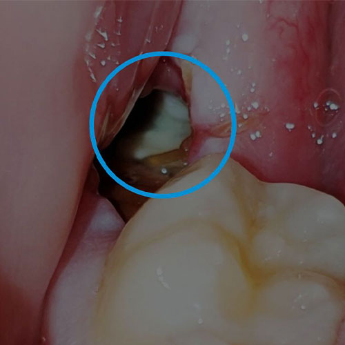 ترمیم دندان عقل