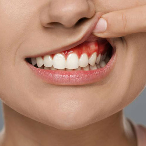 مراحل جرمگیری دندان