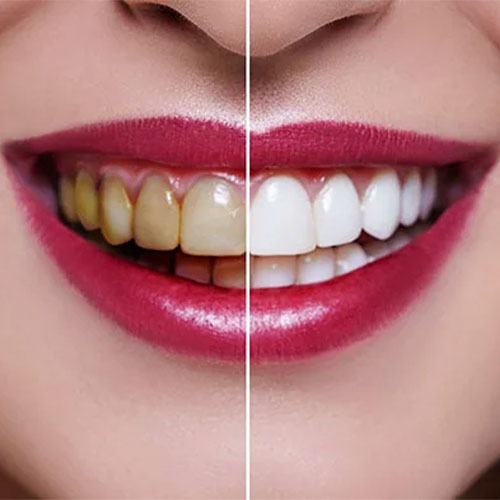 قیمت بلیچینگ دندان در ایران