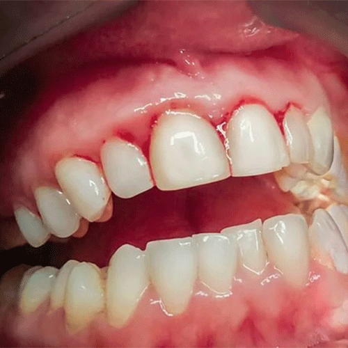 ژنژیویت (التهاب لثه) چیست؟