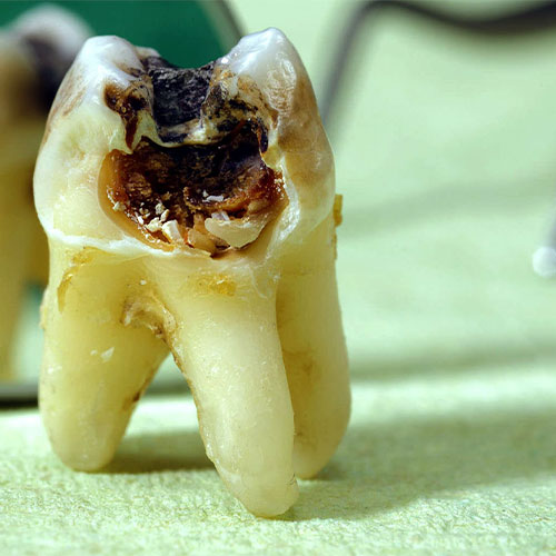 پوسیدگی دندان چگونه ایجاد میشود؟