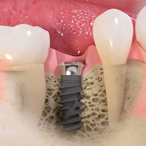 علل درد و ناراحتی بعد از ایمپلنت