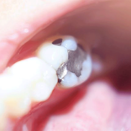 ترمیم با آمالگام (پرکردگی نقرهای)