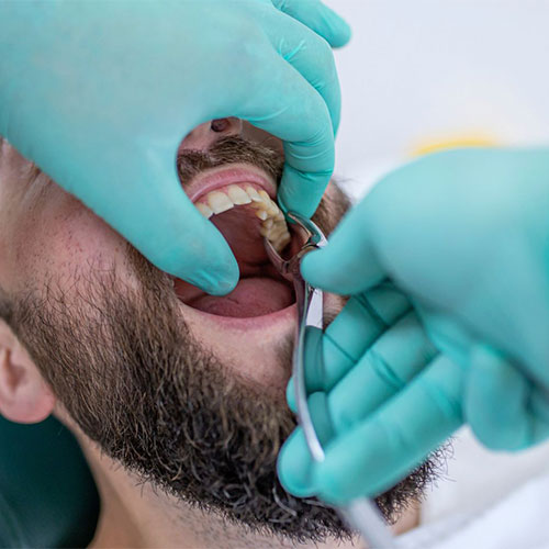 مراحل کشیدن دندان