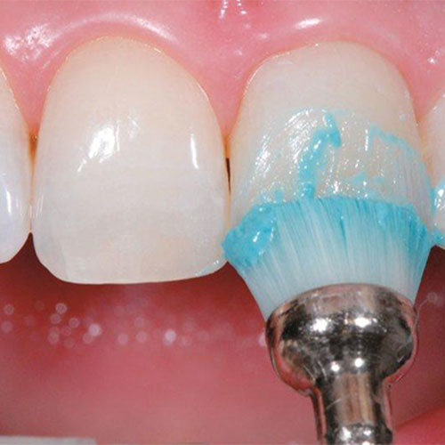 انواع پولیش دندان