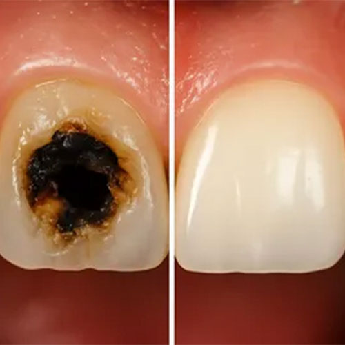 مراحل پوسیدگی دندان