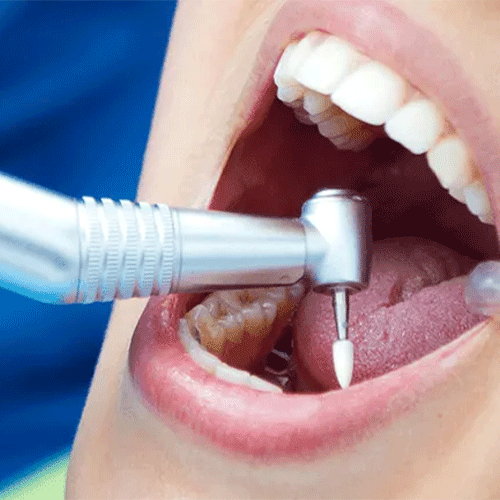 عصب‌کشی دندان جلو