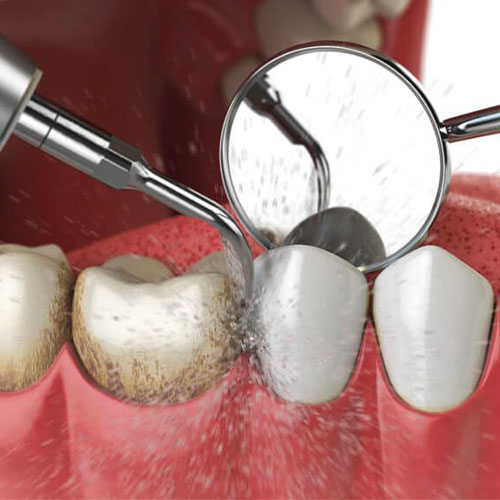 چند ساعت پس از جرمگیری دندان میتوان غذا خورد؟