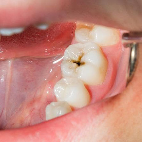 علتهای اصلی پوسیدگی دندان