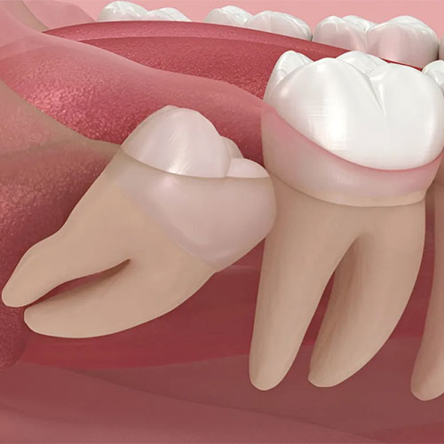 انواع دندان عقل