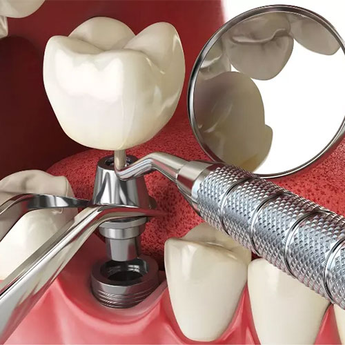 مراحل انجام ایمپلنت