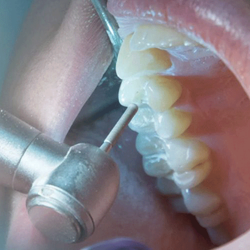 دلایل بروز درد بعد از عصب کشی دندان