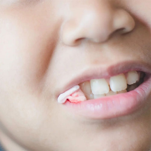 مراقبت‌های بعد از کشیدن دندان