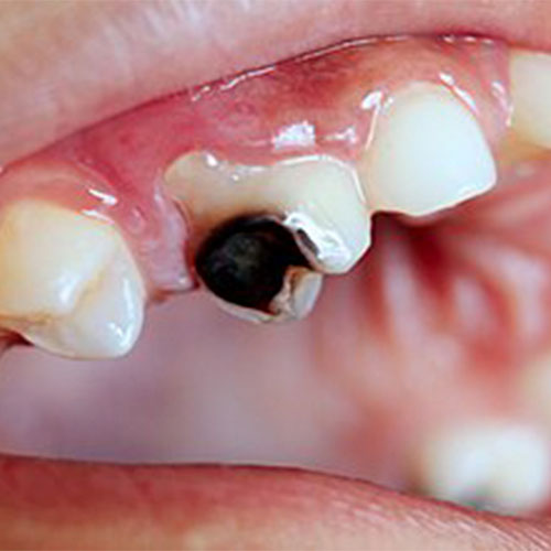 چرا درمان بهموقع پوسیدگی دندان اهمیت دارد؟