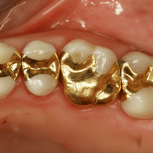 ترمیم با طلا