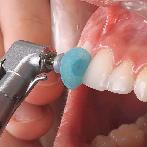 تفاوت پولیش دندان با بلیچینگ چیست؟