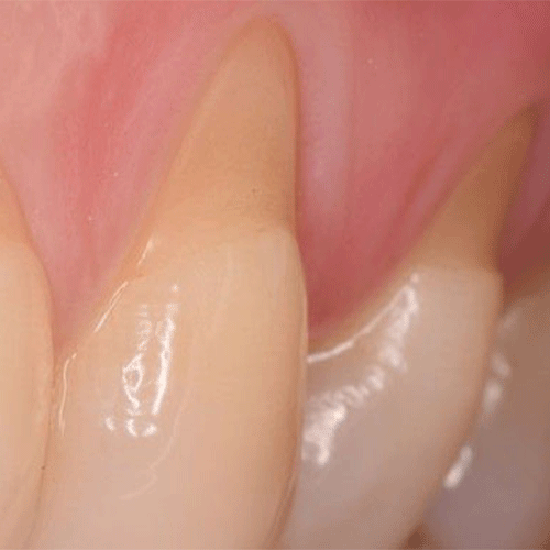 تحلیل لثه‌ها