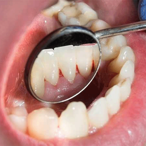 روشهای تشخیص بیماریهای لثه