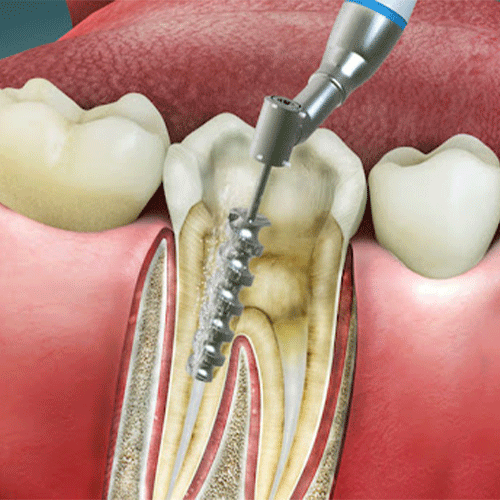 اندو دندان چیست؟