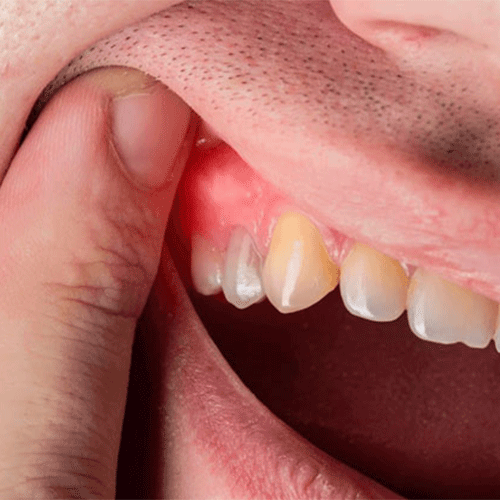 پریودنتیت چیست؟