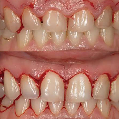چرا جراحی CL انجام میشود؟