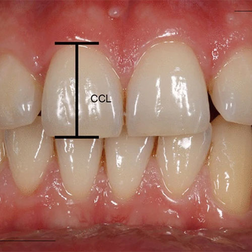 مراحل انجام جراحی CL (افزایش طول تاج دندان)